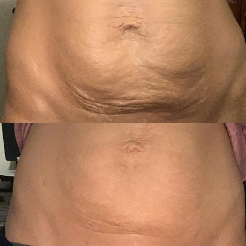 Vaultrys™ - Anti-Cellulite Elixir
